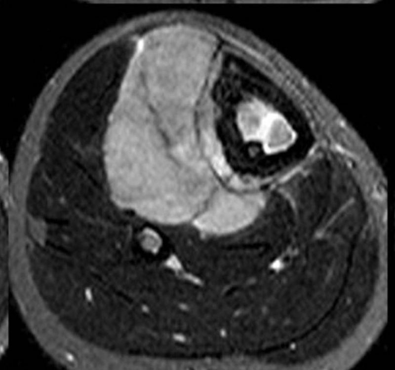 Sarcoma de Ewing - Figura 6