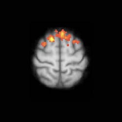 Los video juegos mejoran las conexiones cerebrales en pacientes con EM Video Games Brain