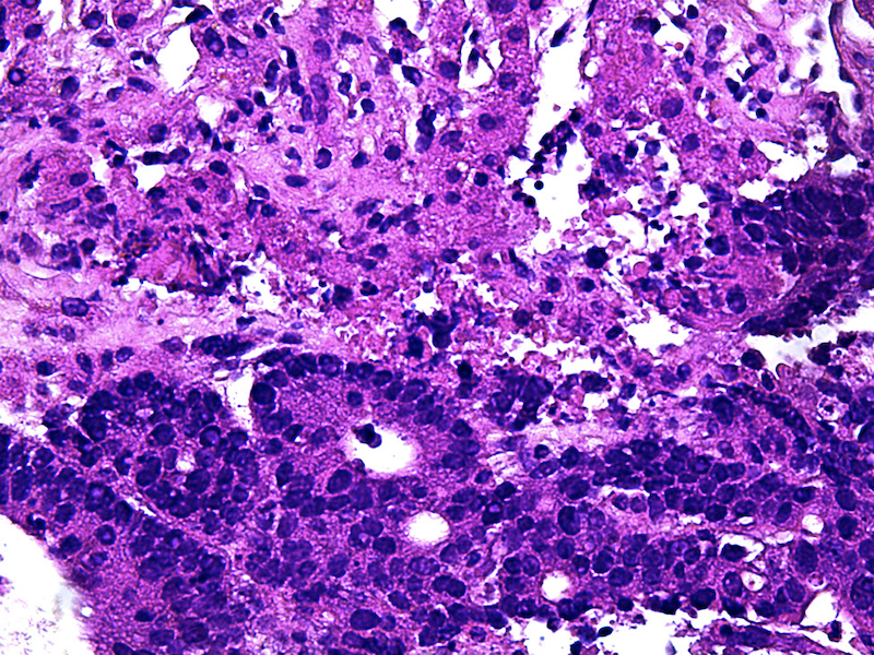 Metástasis única en hígado de adenocarcinoma