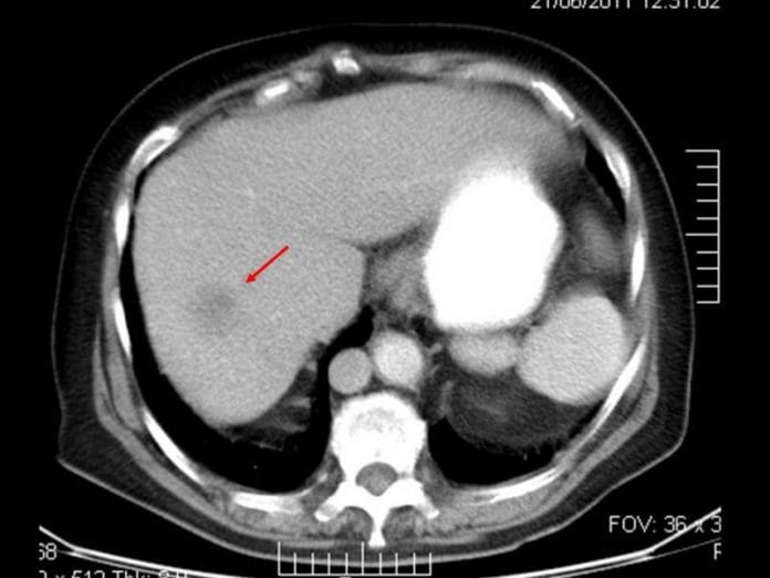 Síndrome de heterotaxia (Situs ambiguo) - Diagnóstico Journal