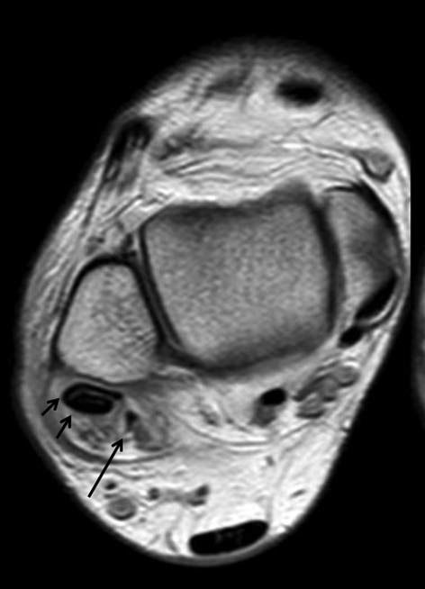 Fig. 3: RM axial DP. Se identifica el músculo accesorio peroneo