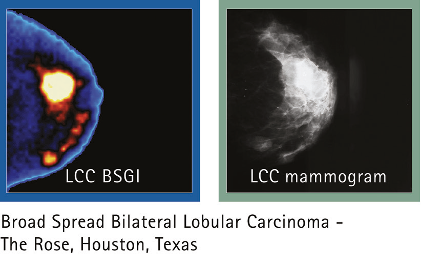 Carcinoma Lobular Bilateral