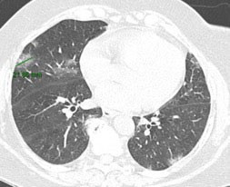 Imagen 3. CT de tórax ventana pulmonar paciente rt PCR + lesiones pseudonodulares en vidrio esmerilado menores a 3 cm, con predominantemente distribución periférica.
