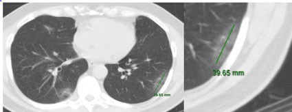 Imagen 4. CT tórax ventana pulmonar paciente COVID-19  con lesiones en vidrio esmerilado periféricas, una de ellas mayor a 3 cm, ver imagen ampliada.