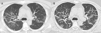 Imagen 5. Paciente femenina de 86 años PCR positiva CT Tórax ventana pulmonar con múltiples imágenes  en vidrio esmerilado, periférico, mayores a 3 cm, se destaca en segmento superior del lóbulo inferior derecho  VE con engrosamiento intersticial y tendencia a la consolidación. Score CT probable moderado-severo.