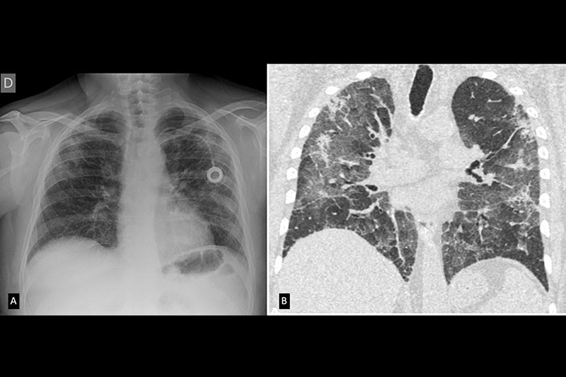 Figura 3 Paciente Maculino 63 años, inmuno suprimido, trasplante de médula ósea Covid + A evidencia Radiografía y B Reconstrucción MIP, vista coronal donde se evidencia que predomina en la periferia.