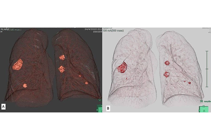 Figura 4  A y B Mismo paciente Covid + evaluado con Synapse 3D para calcular el grado de compromiso pulmonar arrojando 1%