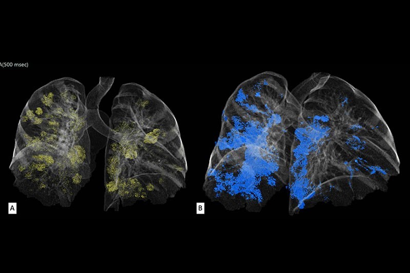 Figura 5 A y B Ambos pacientes Covid + evaluados con Synapse 3D para calcular el grado de compromiso pulmonar arrojando 20 % en A y 30 % en B