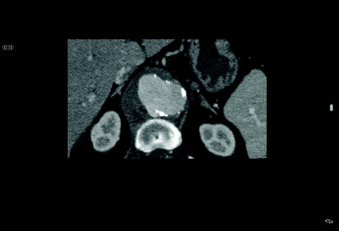 Aneurisma micótico de la aorta: lo que el radiólogo debe conocer ...