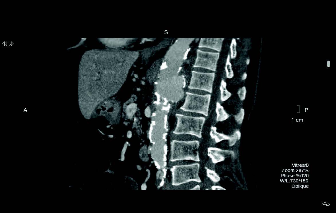 Aneurisma micótico de la aorta: lo que el radiólogo debe conocer ...