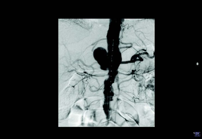 Aneurisma micótico de la aorta: lo que el radiólogo debe conocer ...