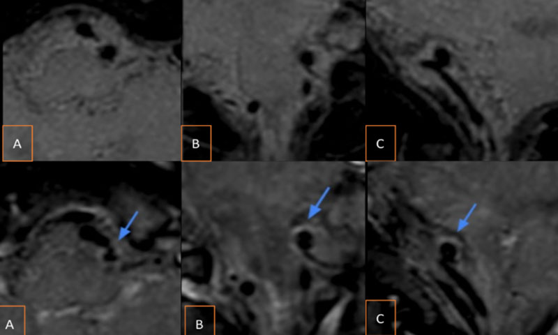 Figura 3. RM cerebro, secuencia de sangre negra (T1 volumétrica). Arriba: secuencias  pre- contraste cortesaxial (A), coronal (B), sagital (C), con foco en el aneurisma localizado en la PICA izquierda. Abajo: secuencias post-contraste que demuestra el realce parietal (proceso inflamatoria parietal, Flecha azul)