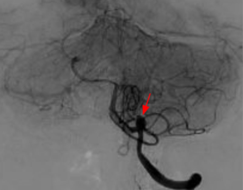 Figura 4. Angiografía cerebral digital que evidencia aneurisma sacular pequeño en el origen de la PICA izquierda, con pseudo-aneurisma asociado, responsable del sangrado (Flecha roja), confirmando los hallazgos de la resonancia magnética; se trató mediante embolización con microcoils de platino.