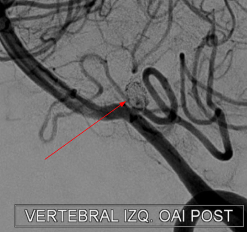 Figura 5. Angiografía cerebral digital que demuestra la exclusión del aneurisma responsable del sangrado (Flecha roja).