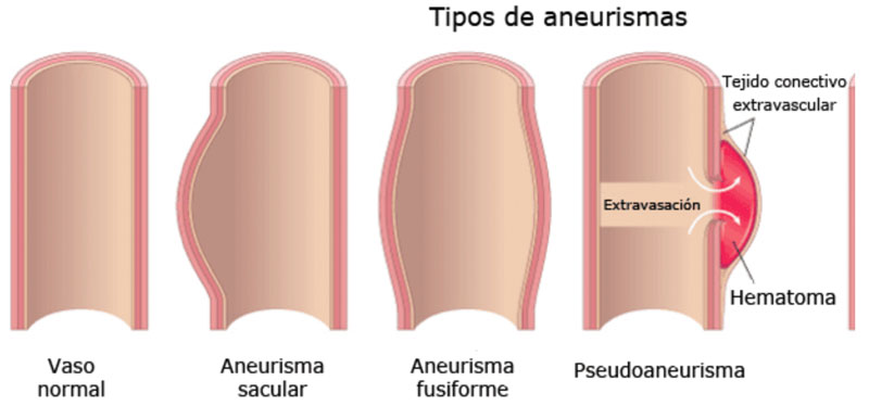Figura 2 Características diferenciales de los aneurismas, pseudoaneurismas .