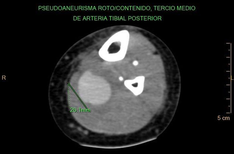 Figura 4 Corte axial de estudio tomográfico con contraste endovenoso de la pierna izquierda el cual demuestra dilatación de la arteria tibial posterior a nivel del tercio medio. (pseudo aneurisma roto y contenido).