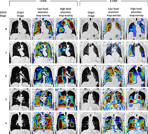 Figura 4. Visualización de mapas de atención de las redes de atención residual para los modelos de red neuronal convolucional inspiratoria (I-CNN) y red neuronal convolucional espiratoria (E-CNN). Los mapas de atención resaltan regiones de la imagen de entrada que contribuyen a las predicciones de la red. Las características de bajo nivel (detalles menores, como la textura) y las características de alto nivel (detalles principales, como la forma) se muestran superponiendo una única sección coronal de las imágenes de TC de entrada sin contraste originales. El color de superposición indica la intensidad de la atención (es decir, la intensidad de la contribución) que va desde la baja atención (azul) hasta la alta atención (rojo oscuro). Se muestra un ejemplo para cada etapa de la Iniciativa Global para la Enfermedad Pulmonar Obstructiva Crónica (GOLD).