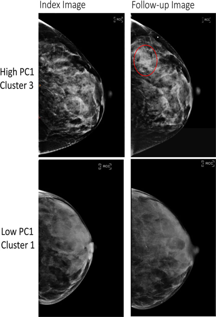 Figura 3. Las imágenes de mamografía digital de campo completo (FFDM) en una mujer de 52 años muestran un fenotipo de alto riesgo (arriba), y las imágenes de FFDM en una mujer de 58 años muestran un fenotipo de bajo riesgo (abajo). El fenotipo de alto riesgo se definió por tener valores altos del primer componente principal (PC1) y se asignó al grupo 3 (fila superior), y el fenotipo de bajo riesgo se definió por tener valores bajos del PC1 y se asignó al grupo 1 (fila inferior). Se proporcionan las imágenes índice (lado izquierdo; antes de cualquier diagnóstico de cáncer), así como las imágenes de seguimiento obtenidas en el momento del diagnóstico de cáncer (para el fenotipo de alto riesgo, arriba a la derecha) o en el último seguimiento (fenotipo de bajo riesgo, abajo a la derecha). El círculo rojo indica la ubicación del cáncer de mama posterior. Ambas mujeres tenían una densidad mamaria de C según el Sistema de Datos e Informes de Imágenes Mamarias. La mujer con alto riesgo de cáncer de mama era negra y la mujer con bajo riesgo de cáncer de mama era blanca.