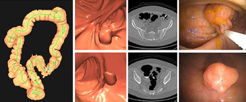 Figura 2. Imágenes de un resultado positivo en una colonografía por TC (CTC) en un hombre asintomático de 67 años. El mapa tridimensional del colon de la CTC (imagen izquierda) muestra la ubicación de dos pólipos sigmoideos detectados (puntos rojos). Las imágenes tridimensionales endoluminales y bidimensionales transversales confirmatorias de la CTC muestran un gran pólipo pediculado de 1,6 cm en la fila superior (flecha) y un pólipo pediculado de 9 mm en el sigmoide distal en la fila inferior (flecha). Ambos pólipos se confirmaron y resecaron mediante una colonoscopia óptica realizada el mismo día (imágenes derechas), lo que evitó una segunda preparación intestinal. El pólipo más grande resultó ser un adenoma tubulovelloso (adenoma grande y avanzado), mientras que el más pequeño fue un adenoma tubular no avanzado. Compare este nivel de información de un resultado positivo en una prueba de cribado con CTC con un resultado positivo en una prueba de ADN en heces multidiana, para el cual no se proporciona información específica.
