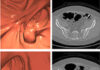 Colonografía (TC) supera la prueba de ADN en heces para la detección de cáncer de colon