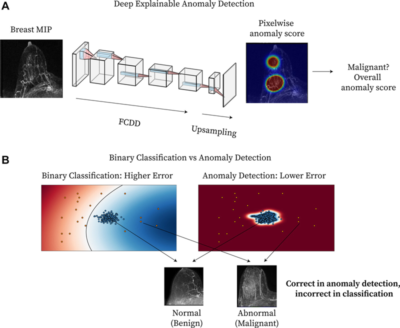 Figura 1. Resumen del método. (A) El diagrama muestra la detección profunda de anomalías explicables en la resonancia magnética de mama. Se pasa una proyección de intensidad máxima (MIP) de una mama a un modelo de red neuronal completamente convolucional entrenado mediante una función de pérdida de detección de anomalías explicable (descripción de datos completamente convolucional [FCDD]). (B) El diagrama muestra una comparación conceptual entre la clasificación binaria y la detección de anomalías: el sombreado representa los espacios de características normales (azul) y anormales (rojo) aprendidos, y los puntos representan casos individuales normales (azul) y anormales (rojo).