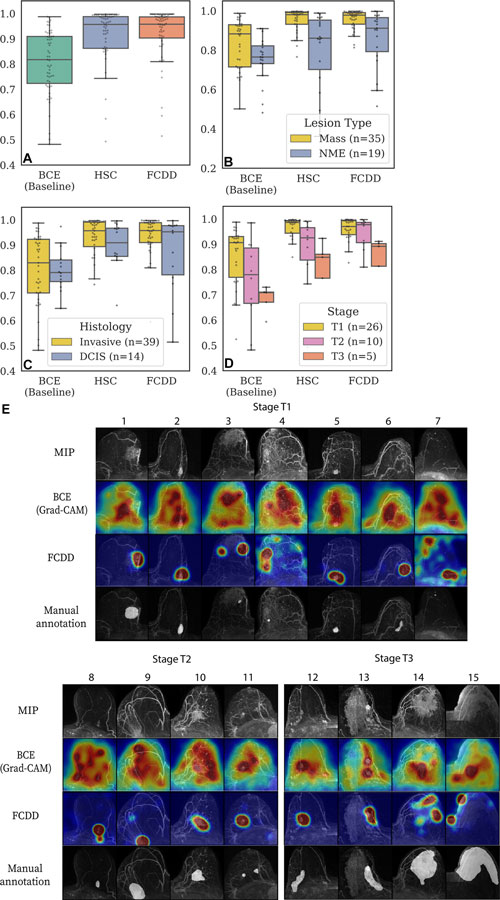 Figura 5.  Validación de mapas de calor de explicación de modelos en el conjunto de prueba de explicación segmentado por lesiones. (A–D) Los diagramas de caja y bigotes muestran el área bajo la curva característica operativa del receptor (AUC) a nivel de píxel para tres modelos: entropía cruzada binaria (BCE), clasificación de hiperesferas (HSC) y descripción de datos completamente convolucional (FCDD), utilizando la anotación retrospectiva del radiólogo como estándar de referencia. Cada punto corresponde al AUC a nivel de píxel entre un mapa de calor de explicación y la anotación del radiólogo en una imagen de mama. Se muestran datos para (A) todas las imágenes en el conjunto de prueba de explicación, (B) imágenes estratificadas por tipo de lesión, (C) imágenes estratificadas por carcinoma invasivo versus carcinoma ductal in situ (DCIS) y (D) imágenes estratificadas por estadio T para casos invasivos. Los casos con múltiples lesiones de diferentes tipos y características histológicas en la misma mama se excluyeron de B (un caso) y C (dos casos). (E) Se muestran las proyecciones de intensidad máxima (MIP), los mapas de saliencia de la BCE, los mapas de anomalías de la FCDD y las anotaciones del radiólogo para una muestra aleatoria de casos de prueba con lesiones en estadios T1, T2 y T3. Todos los mapas de explicación están normalizados localmente. Las mamas con lesiones pequeñas (p. ej., caso 7) o múltiples (p. ej., casos 11 y 12) tendieron a presentar peores explicaciones. Las lesiones más grandes en estadio T3 (p. ej., casos 14 y 15) tendieron a ser mal explicadas por los mapas de la BCE; aunque los mapas de la FCDD fueron más consistentes, tendieron a subestimar el tamaño de la región afectada.