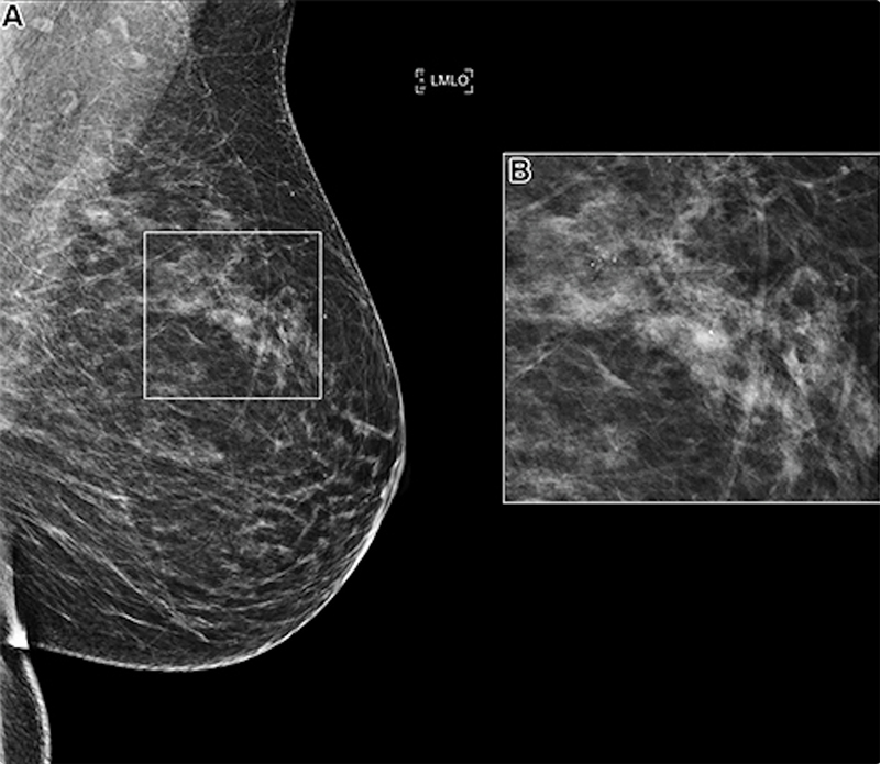 Figura 1. (A) Mamografía oblicua mediolateral izquierda (LMLO) en una mujer de 58 años con un área de microcalcificación (recuadro). (B) Vista ampliada (2,2×) del recuadro en A. Este caso fue recuperado por los 10 principales algoritmos de inteligencia artificial, pero se determinó que era benigno en el análisis de la biopsia.