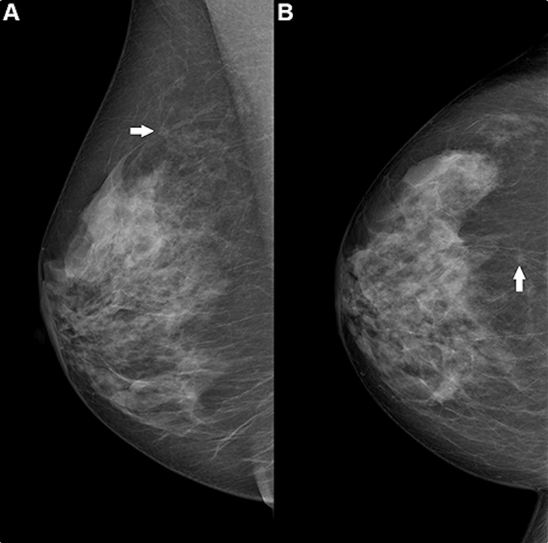 Figura 2. Mamografía de mama derecha en una mujer de 69 años. Se observa una masa espiculada de 6 mm en la posición de las 12 en punto (flecha), visible tanto en la proyección oblicua mediolateral (A) como en la craneocaudal (B) . Este caso no fue recuperado por ninguno de los 10 mejores algoritmos de inteligencia artificial, pero se trataba de un carcinoma invasivo diagnosticado mediante biopsia.
