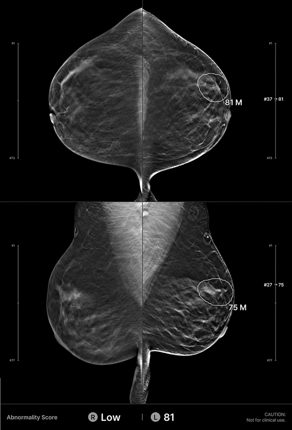 Figura 2. Ejemplo de un cáncer de intervalo detectado retrospectivamente mediante el algoritmo de inteligencia artificial (IA). Una mujer de 41 años se presentó para una tomosíntesis digital mamaria de cribado; los resultados se interpretaron como negativos. Diez meses después, la paciente presentó un bulto en la mama izquierda y posteriormente se le diagnosticó carcinoma ductal invasivo de grado 3. En la evaluación retrospectiva de la mamografía de cribado inicial, el algoritmo de IA detectó una lesión sospechosa (contorno blanco) en la mama izquierda, con puntuaciones altas de 81 en la proyección craneocaudal y 75 en la proyección oblicua mediolateral. Esta área de distorsión arquitectónica corresponde al cáncer diagnosticado posteriormente.