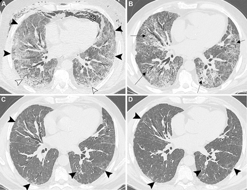Figura 1. Imágenes de TC axial sin contraste muestran anomalías residuales post-COVID-19 en un paciente masculino de 69 años con antecedentes de tabaquismo e infarto de miocardio. (A) La imagen basal obtenida al ingreso en el departamento de cuidados intensivos muestra opacidades extensas en vidrio deslustrado y consolidación bilateral leve (puntas de flecha negras), asociadas con un patrón en empedrado (puntas de flecha blancas), neumomediastino espontáneo (*) y enfisema subcutáneo bilateral de la pared torácica anterior. (B) La imagen obtenida un mes después muestra la resolución completa del neumomediastino y el enfisema subcutáneo, con opacidades bilaterales difusas persistentes en vidrio deslustrado y opacidades reticulares. También se observa una leve distorsión de la arquitectura pulmonar y bronquial (flechas). El paciente fue dado de alta con instrucciones de usar oxígeno suplementario durante el esfuerzo y por la noche. (C) La imagen obtenida 4 meses después del inicio muestra la reducción de las opacidades en vidrio deslustrado y reticulares previas, con áreas residuales irregulares de opacidades leves en vidrio deslustrado y opacidades reticulares finas que muestran distribución subpleural y peribroncovascular (puntas de flecha) en ambos pulmones. La dilatación bronquial observada previamente muestra mejoría. El paciente refirió disnea de esfuerzo leve persistente, y las pruebas de función pulmonar revelaron un patrón restrictivo leve y una capacidad pulmonar de difusión de monóxido de carbono ligeramente reducida. (D) La imagen obtenida al año de seguimiento muestra una resolución casi completa de las anomalías pulmonares posteriores a la COVID-19, con solo opacidades residuales mínimas en vidrio deslustrado y una leve distorsión de la arquitectura pulmonar (puntas de flecha).