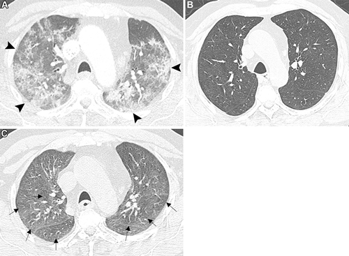 Figura 2. Las imágenes axiales de TC de tórax muestran atrapamiento aéreo tras una neumonía por COVID-19 en un paciente masculino de 61 años con disnea de esfuerzo leve persistente y tos seca. (A) La imagen con contraste muestra áreas irregulares de consolidación y opacidades en vidrio deslustrado con distribución subpleural y peribroncovascular en los lóbulos superiores (puntas de flecha), compatibles con neumonía por COVID-19. (B) La imagen inspiratoria completa sin contraste, obtenida 10 meses después debido a la disnea de esfuerzo leve persistente y la tos seca, muestra la resolución completa de las anomalías pulmonares bilaterales previas. (C) La imagen espiratoria completa sin contraste muestra áreas irregulares hipodensas de atrapamiento aéreo en los lóbulos superiores (flechas). Las imágenes inspiratorias muestran ausencia de atenuación en mosaico.