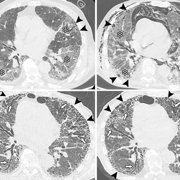 Figura 3. Imágenes axiales de TC sin contraste muestran neumonía por COVID-19 en un paciente masculino de 83 años con enfermedad pulmonar intersticial (EPI) preexistente. (A) La imagen muestra opacidades en vidrio deslustrado en los lóbulos inferiores y en la língula (*). Se evidencian opacidades reticulares irregulares con bronquiectasias por tracción distal leves en las regiones subpleurales de ambos lóbulos superiores (puntas de flecha), lo que sugiere EPI preexistente con un probable patrón de neumonía intersticial habitual. (B) La imagen obtenida durante la hospitalización por dificultad respiratoria muestra neumomediastino espontáneo y enfisema subcutáneo difuso de la pared torácica, predominantemente en el lado izquierdo. La imagen también muestra opacidades difusas persistentes en vidrio deslustrado (*) y cambios pulmonares fibróticos periféricos (puntas de flecha). (C) La imagen de seguimiento sin contraste obtenida a los 6 meses muestra la naturaleza progresiva de la fibrosis pulmonar, con el desarrollo de panalización (puntas de flecha) y bronquiectasias graves (flechas), que afectan predominantemente las regiones periféricas anteriores de ambos pulmones. (D) La imagen de seguimiento sin contraste, obtenida a los 14 meses, muestra la progresión del panal de abejas (puntas de flecha) y bronquiectasias graves (flechas) en la región periférica anterior de ambos pulmones. En este caso, la infección por SARS-CoV-2 probablemente actuó como desencadenante de la exacerbación de una EPI fibrótica no diagnosticada previamente, y la ventilación mecánica podría contribuir a la fibrosis extensa en la región anterior del pulmón (puntas de flecha). El paciente recibió tratamiento antifibrótico tras la resolución de la fase aguda.