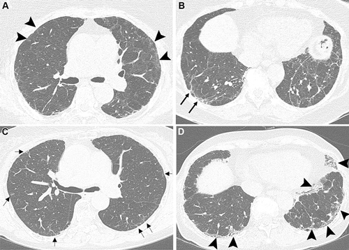 Figura 4. Las imágenes de TC axial sin contraste muestran (A, B) anomalías pulmonares residuales post-COVID-19 en una paciente femenina de 70 años y (C, D) anomalías pulmonares intersticiales fibróticas en una paciente femenina de 63 años. (A) La imagen a nivel de la carina obtenida a los 15 meses de seguimiento muestra opacidades en vidrio deslustrado tenues multifocales post-COVID-19 y atenuación en mosaico en los lóbulos superiores (puntas de flecha). (B) La imagen muestra una banda parenquimatosa (flechas) en el lóbulo inferior derecho y opacidades perilobulillares a lo largo de las áreas peribroncovasculares y subpleurales del lóbulo inferior izquierdo (línea de puntos ovalada). Las bandas parenquimatosas y las opacidades perilobulillares son inusuales en las anomalías pulmonares intersticiales y respaldan el diagnóstico de neumonía organizada residual post-COVID-19. (C) La imagen obtenida en 2019 muestra anomalías pulmonares intersticiales fibróticas. La imagen a nivel de la carina muestra opacidades lineales subpleurales mínimas en los lóbulos superiores y el segmento superior del lóbulo inferior izquierdo (flechas). (D) La imagen muestra opacidades reticulares yuxtapleurales, bronquiolectasias por tracción y opacidades en vidrio deslustrado, que afectan principalmente ambos lóbulos inferiores (puntas de flecha).