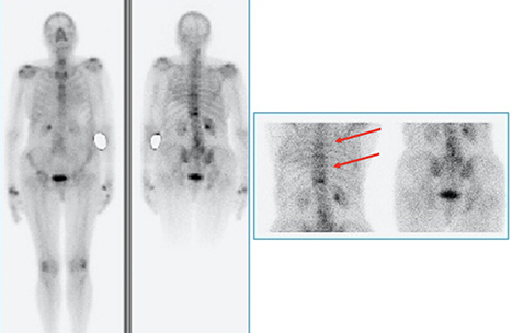 Fig 2. Distribución heterogénea del compuesto en raquis, destacándose mayor captación
en proyección de D7-D11, últimas lumbares, que si bien impresiona de origen osteoartrósico,
asociado a escoliosis. Se sugiere correlación clínico‑anatómica.