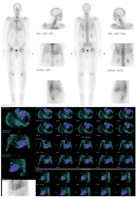 Fig 3. Barrido corporal: Cambios osteoarticulares degenerativos. Se visualizó captación
aumentada y difusa del trazador en miocardio, hallazgo incidental que motivó la adquisición
de imágenes planares y SPECT según protocolo para ATTR.