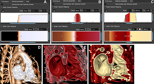 Figura 1. Demostración de la función de transferencia y la representación volumétrica resultante en una paciente de 6 años con comunicación interventricular derecha (VD-A) y defecto del tabique ventricular (PA) con mala alineación, considerada para reparación biventricular. La función de transferencia aplicada a imágenes rápidas de ángulo bajo con inversión-recuperación, obtenidas mediante resonancia magnética cardíaca con ferumoxitol, altera el color y la opacidad de la imagen tridimensional. (A) Función de transferencia para la representación del medio de contraste en el depósito sanguíneo. (B) Función de transferencia para la representación del miocardio con interior rojo. (C) Función de transferencia para la representación del miocardio con interior claro. (D) Representación volumétrica tradicional. (E) Representación volumétrica del miocardio con interior rojo. (F) Representación volumétrica del miocardio con interior claro. ROI = región de interés.