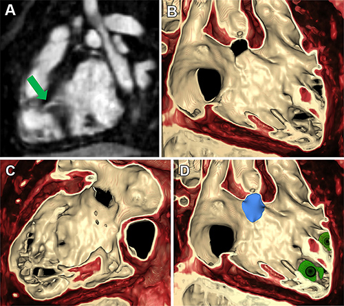 Figura 3. Representación volumétrica de imágenes de RM cardíaca con ferumoxitol mediante navegación basada en imágenes (iNav) para informar sobre el cierre de múltiples defectos del tabique ventricular (CIV) en una paciente de 3 años (paciente 3). (A) La reconstrucción volumétrica multiplanar muestra un CIV muscular (flecha verde). (B) Representación volumétrica del miocardio desde la vista del ventrículo derecho. (C) Representación volumétrica del miocardio desde la vista del ventrículo izquierdo. (D) Simulación del cierre del CIV (azul) y colocación del dispositivo (verde) en imágenes de representación volumétrica.