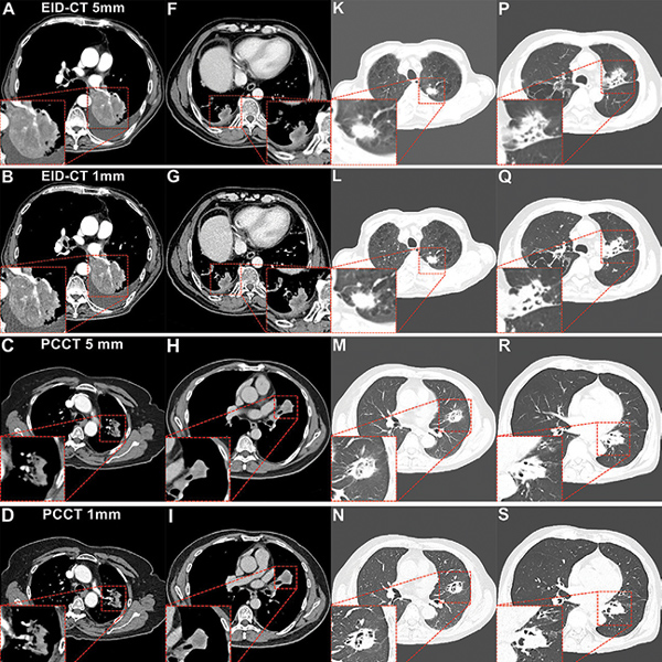 Figura 4. Imágenes de TC de tórax con contraste de cáncer de pulmón obtenidas mediante TC con detector integrador de energía (EID) y TC con conteo de fotones (PCCT). Las áreas resaltadas en rojo resaltan las imágenes magnificadas de las lesiones. (A–E) Signo de convergencia o invasión vascular en las imágenes axiales de la fase arterial. (A, B) Imágenes de TC con EID en un hombre de 74 años con un índice de masa corporal (IMC) de 18,6, calculado como el peso en kilogramos dividido por el cuadrado de la altura en metros, diagnosticado con adenocarcinoma. (C–E) Imágenes de PCCT en una mujer de 72 años (IMC, 20,0) diagnosticada con adenocarcinoma. La delineación y la continuidad de los vasos son más nítidas en las imágenes de PCCT de 0,4 mm. (F–J) El límite del área necrótica dentro del tumor en las imágenes axiales de la fase venosa. (F, G) Imágenes de TC EID en un hombre de 62 años (IMC, 23,8) diagnosticado con carcinoma de células escamosas. (H–J) Imágenes de TCPC en un hombre de 60 años (IMC, 23,6) diagnosticado con carcinoma de células escamosas. La resolución espacial mejorada y la señal de yodo de la TCPC mejoran la delineación del límite del área necrótica dentro del tumor, particularmente en las imágenes de 0,4 mm. (K–O) Lobulación, espiculación y retracción pleural en las imágenes axiales con ventanas pulmonares. (K, L) Imágenes de TC EID en un hombre de 82 años (IMC, 20,8) diagnosticado con adenocarcinoma. (M–O) Imágenes de TCPC en un hombre de 72 años (IMC, 23,5) diagnosticado con adenocarcinoma. En comparación con la TC EID y otros grosores de corte, la PCCT a 0,4 mm ofrece mayor fiabilidad diagnóstica en la detección de espiculaciones sutiles, lobulaciones superficiales y líneas de tracción pleural. (P–T) Estenosis bronquial o signo de corte en las imágenes axiales con ventanas pulmonares. (P, Q) Imágenes de TC EID en un hombre de 70 años (IMC: 20,5) con diagnóstico de carcinoma escamocelular. (R–T) Imágenes de PCCT en un hombre de 58 años (IMC: 21,8) con diagnóstico de carcinoma escamocelular. La PCCT a 0,4 mm mejora la visualización de la estenosis, el truncamiento y la morfología de sus límites en comparación con la TC EID.