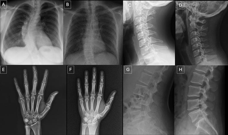 Figura 3. Radiografías reales y generadas por GPT-4o que coinciden con la anatomía: (A) radiografía posteroanterior de tórax real y (B) generada por GPT-4o, (C) radiografía lateral de columna cervical real y (D) generada por GPT-4o, (E ) radiografía posteroanterior de mano real y (F) generada por GPT-4o, y (G) radiografía lateral de columna lumbar real y (H) generada por GPT-4o. Los pares demuestran que GPT-4o puede producir imágenes radiográficamente plausibles en diferentes regiones anatómicas.