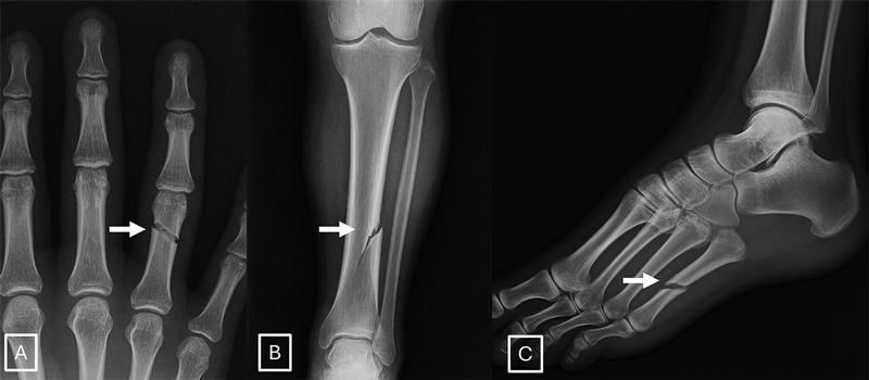 Figura 4. Ejemplos de radiografías de fracturas generadas por GPT-4o: (A) radiografía posteroanterior de la mano, (B) radiografía posteroanterior de la pierna y (C) radiografía oblicua medial del pie. Las imágenes muestran líneas de fractura (flecha) inusualmente lisas, limpias y consistentes y, en el caso de B, unicorticales. La presencia de estas líneas de fractura idealizadas, caracterizadas por una suavidad antinatural y una interrupción cortical incompleta, podría servir como un indicio diagnóstico principal para identificar imágenes de traumatismos generadas por inteligencia artificial.