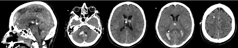 TC de cerebro a las 72 hs posterior a 3 dosis de rTPA