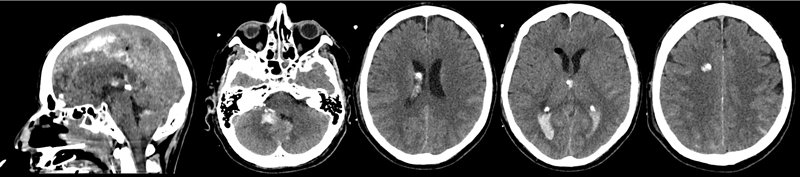 TC de cerebro a las 72 hs posterior a 3 dosis de rTPA