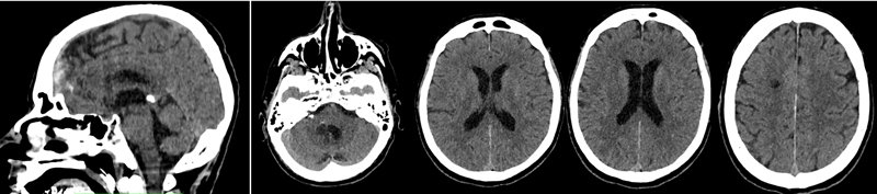TC de cerebro a los 10 días de internación