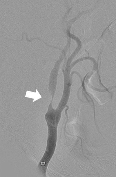 Figura 1. Pretratamiento: Angiografía digital cerebral y de vasos de cuello. La flecha blanca indica la estenosis suboclusiva a nivel de la arteria carótida interna derecha postbulbar que genera disminución del flujo intracerebral.