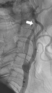 Figura 2. Protección cerebral: Angiografía digital cerebral y de vasos de cuello. La flecha blanca muestra el filtro de protección cerebral desplegado distal a la estenosis para evitar que fragmentos de la placa migren a nivel intracerebral.