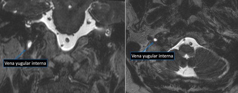 Figura 6. Secuencia T2 balanceada en plano coronal (izquierda) y axial (derecha), mostrando la señal de LCR en la vena yugular interna (IJV) desde dos perspectivas complementarias.